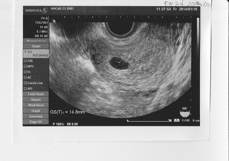 超音波　胎嚢　　妊娠5週